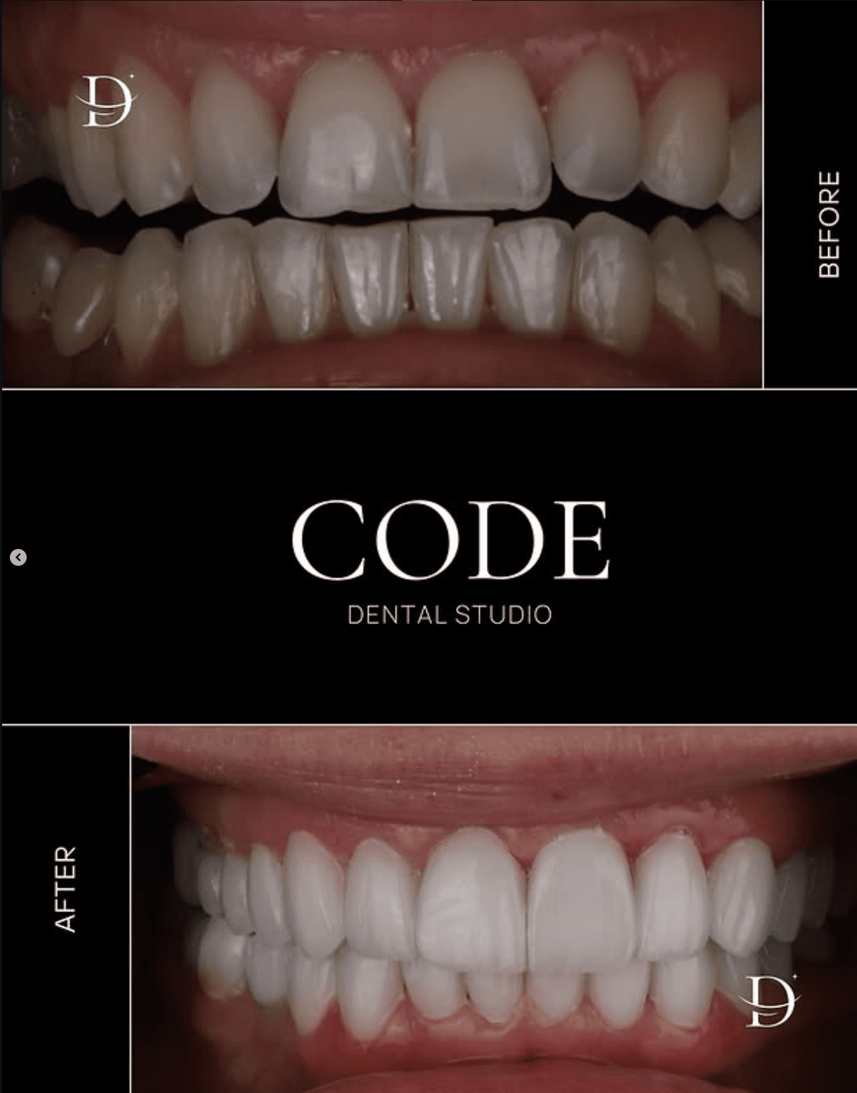 Виниры E-max: коррекция формы и цвета